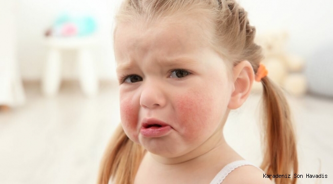 Çocuklarda en sık görülen yaz alerjileri