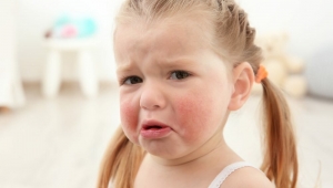 Çocuklarda en sık görülen yaz alerjileri